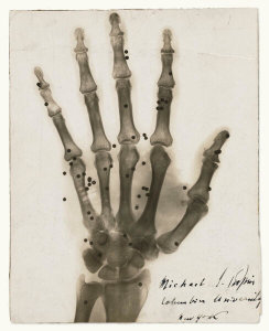 Julius Boldtman - Staged photograph of an 1896 gunshot X-ray, ca. 1930s
