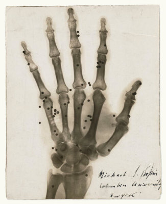 Julius Boldtman - Staged photograph of an 1896 gunshot X-ray, ca. 1930s